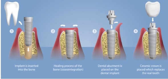 dental-implants-astoria