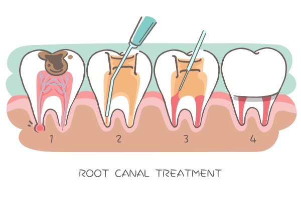 root-canal-astoria
